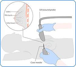 Core biopsy illustration