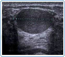 Breast ultrasound image